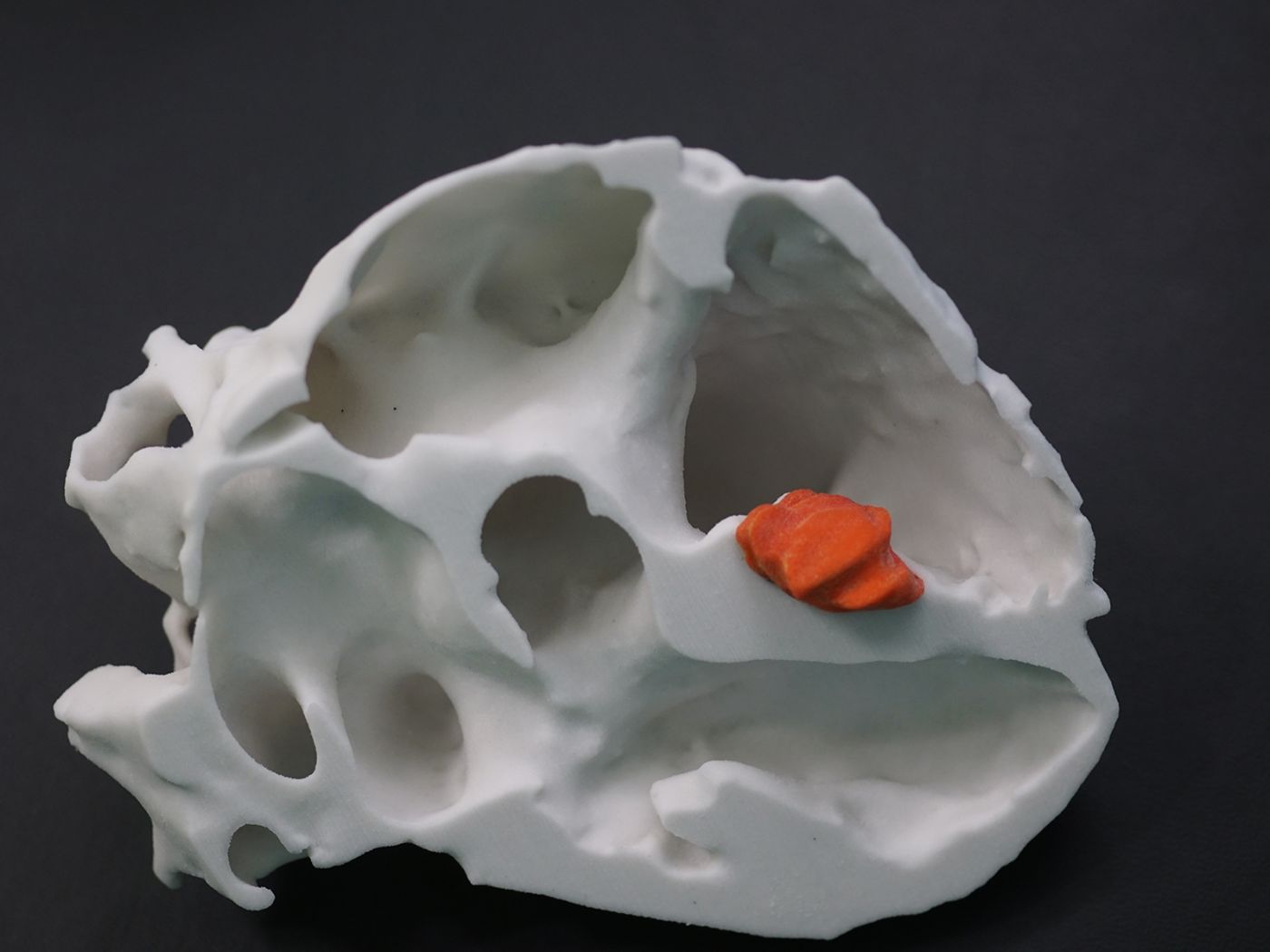 A three-dimensional model of a heart with tumor