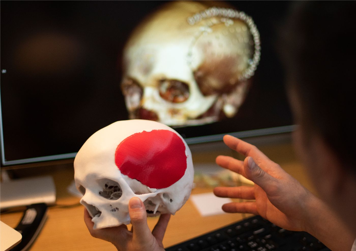3D model of an artificial implant of a skull plate