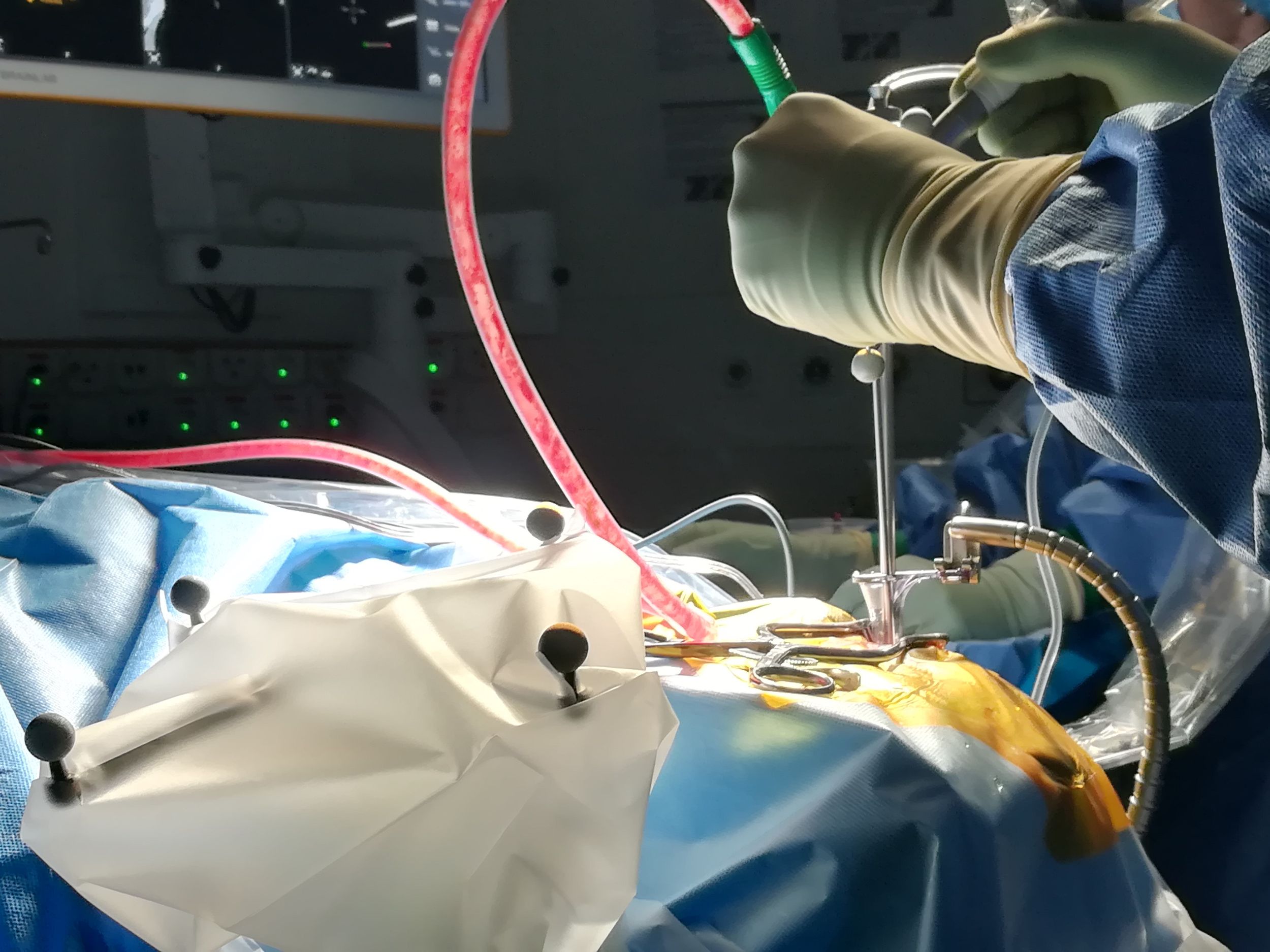 Eine minimalinvasive Operation der Neurochirurgie