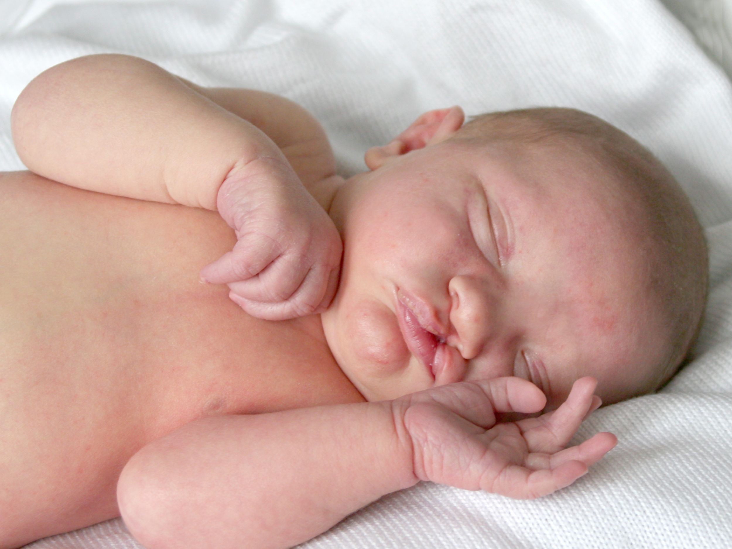 Baby mit Lippen-Kiefer-Gaumenspalte