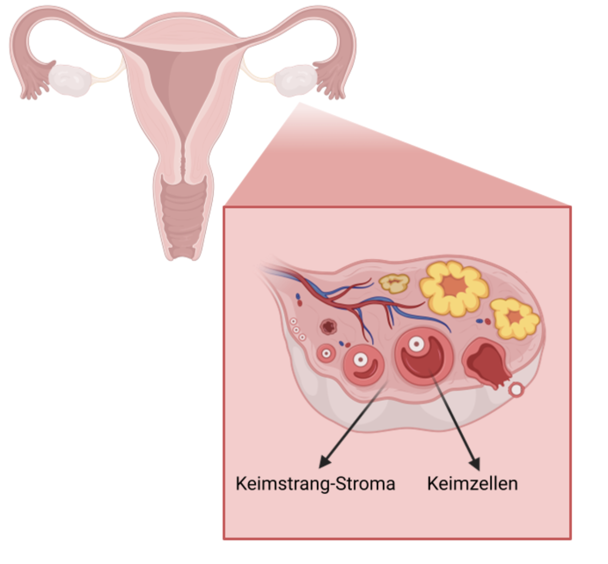 Tumeurs embryonnaires de l'ovaire 