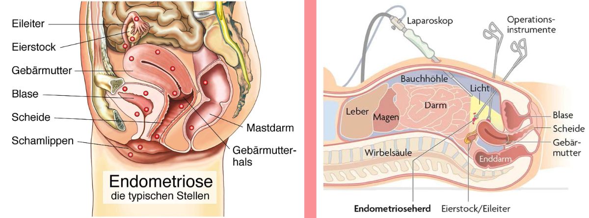 Graphique de l'abdomen d'une femme avec organes marqués et indication du foyer d'endométriose