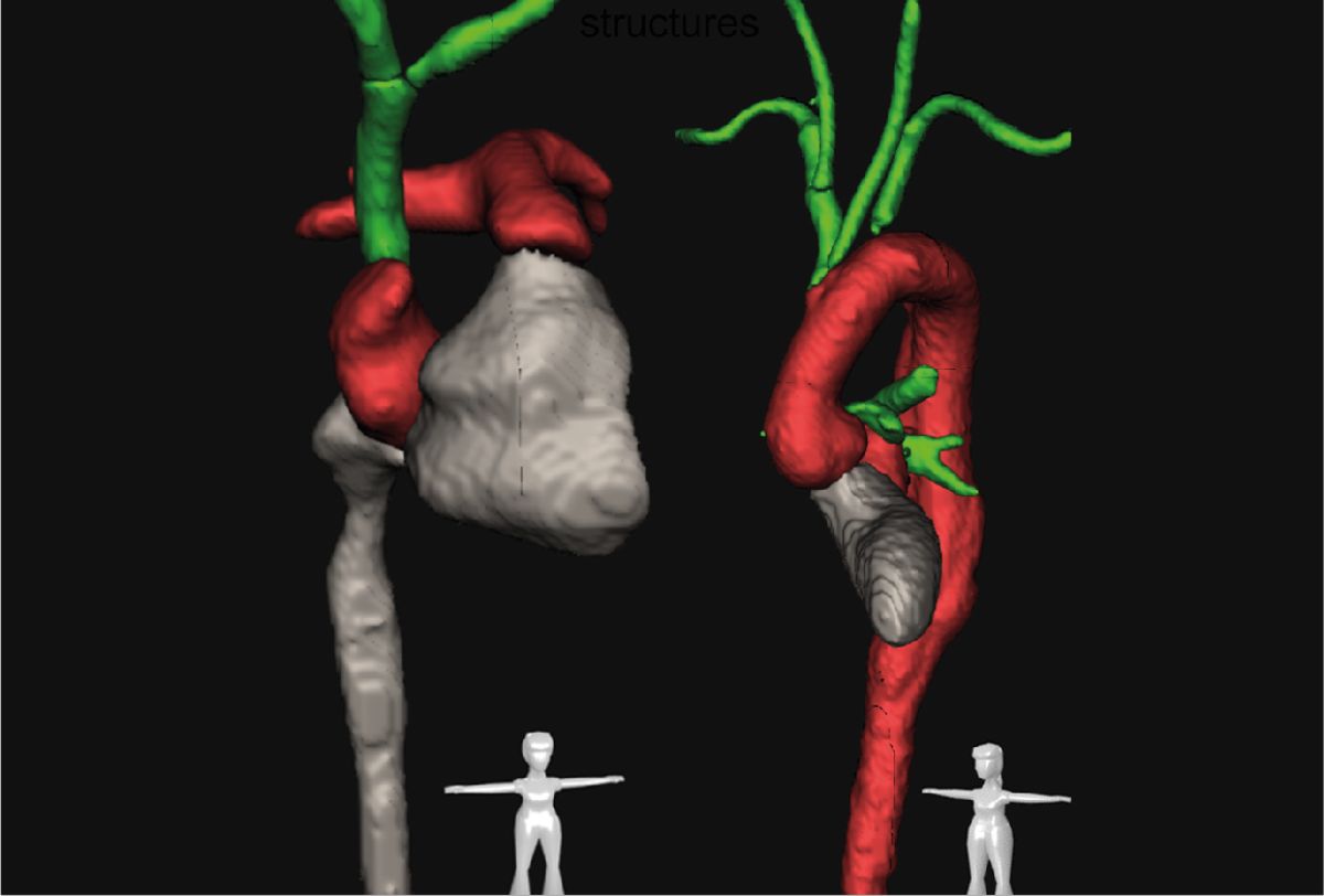 Blutgefässe in der CT