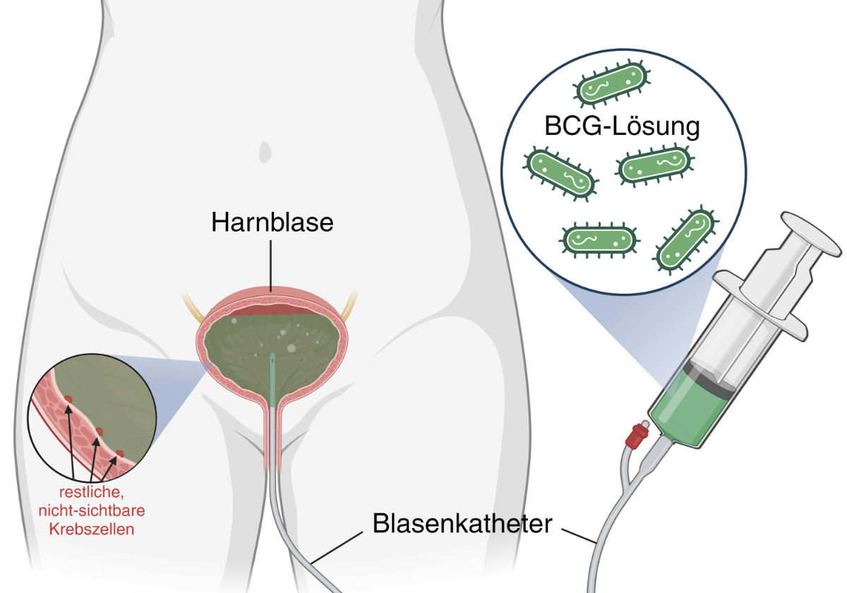 BCG - Patient Illustration