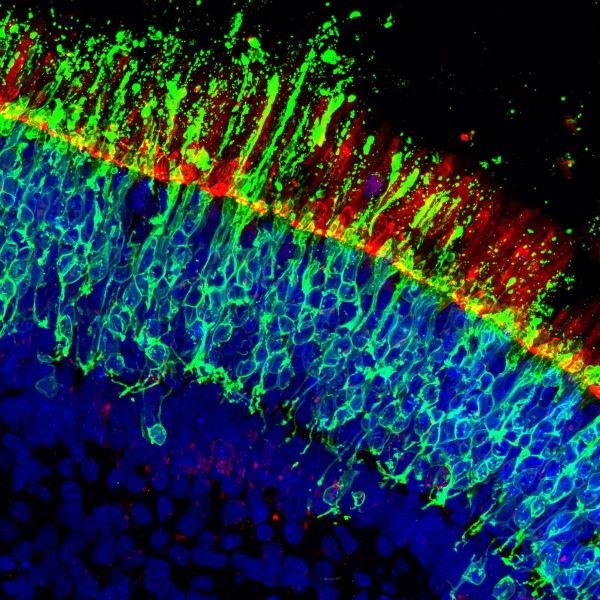 Neue Forschungsergebnisse liefern wichtige Hinweise für neue Behandlungsansätze bei altersbedingter Makuladegeneration, einer der häufigsten Ursachen für zentralen Sehverlust bei älteren Erwachsenen.