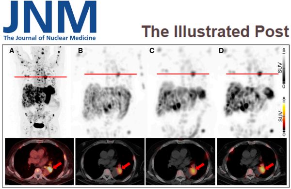Unsere Nuklearmediziner haben, zusammen mit dem Paul Scherrer Institut und dem Uniklinikum Freiburg, zwei etablierte, in Tablettenform existierende Therapien kombiniert und so die Wirksamkeit einer Radioligandentherapie verbessert. Ihre Arbeit wurde vom renommierten Fachjournal als «Illustrated Post» gewürdigt.